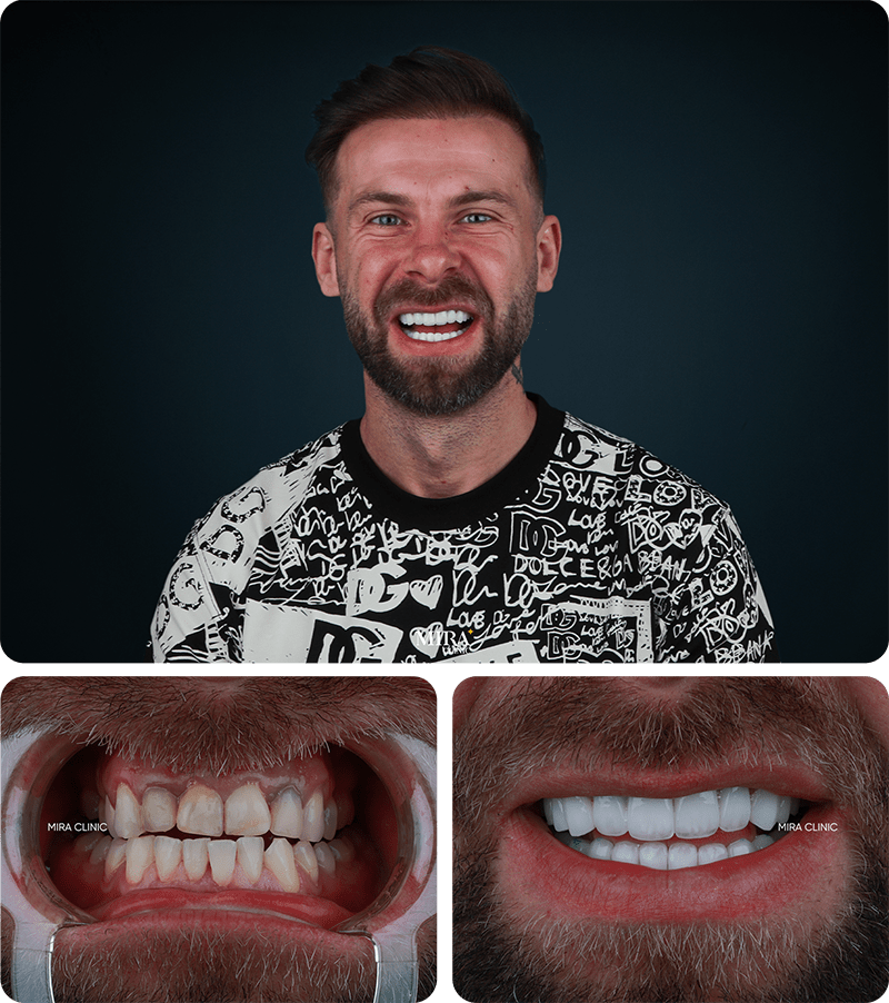 before-after
