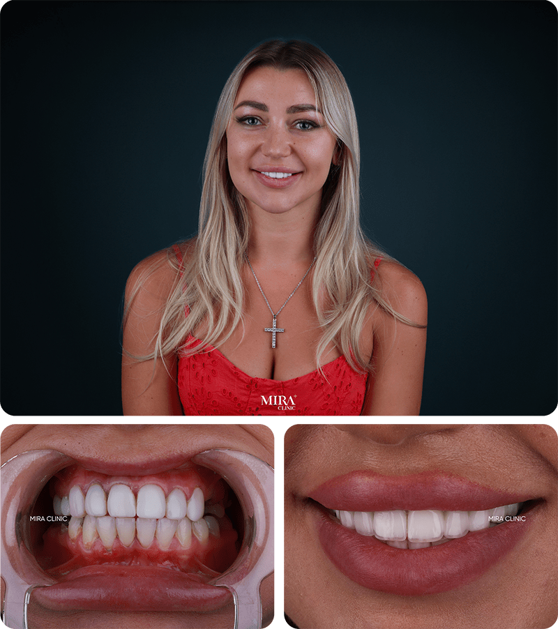 before-after