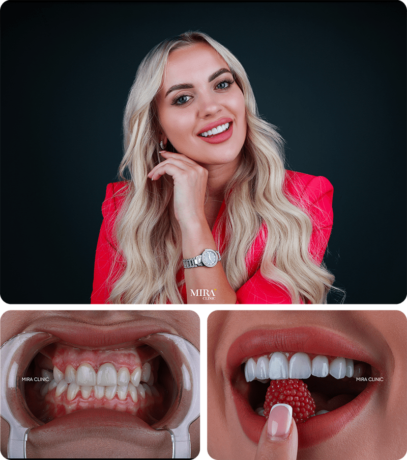 Veneers e-max