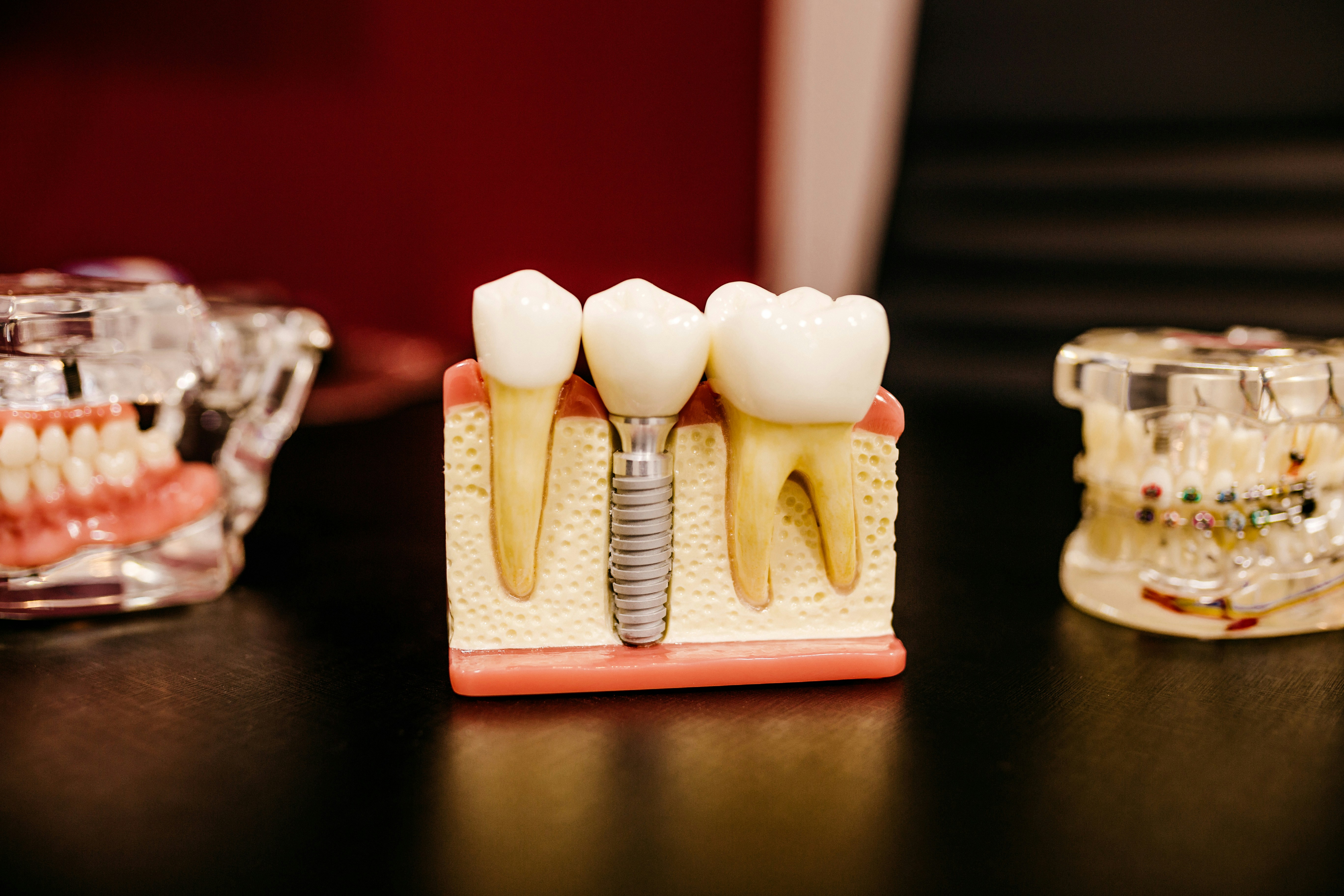 Root Canal